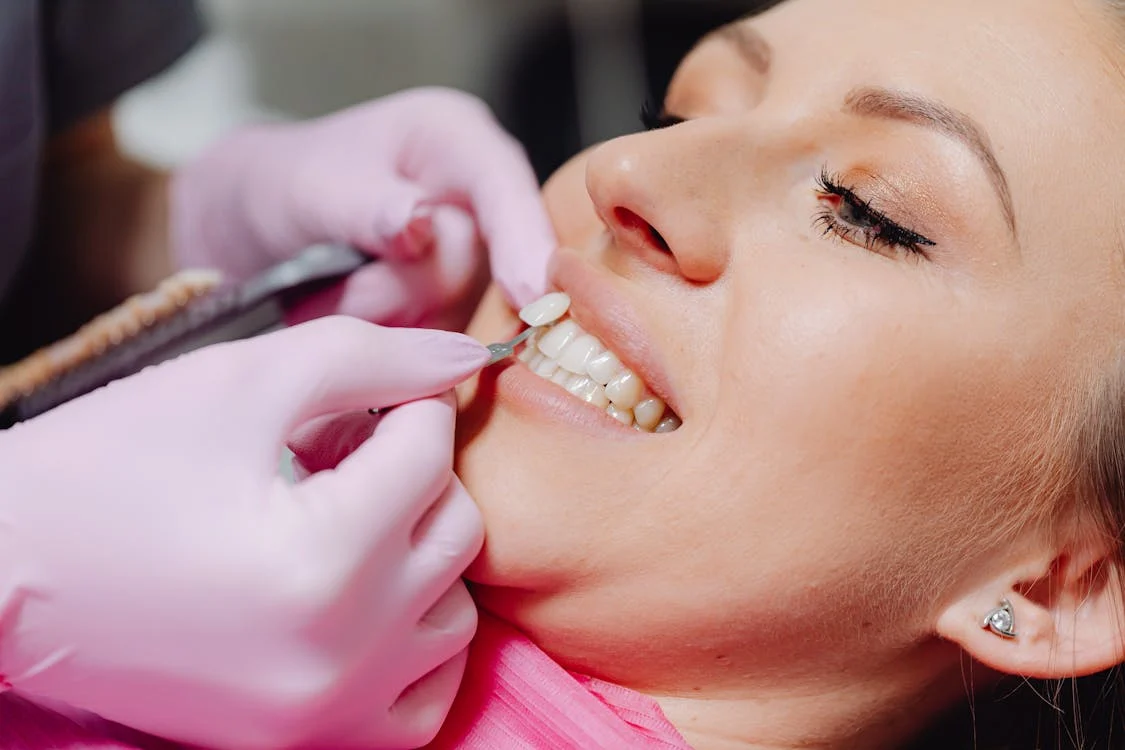 How to Choose Veneers in London